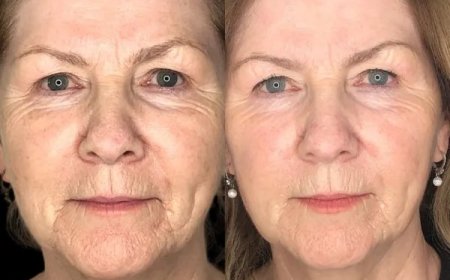 Revive Beauty with Profhilo at Best Aesthetic Clinic in dubai