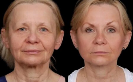 Under Eye Fillers in Dubai: Why Timing Matters