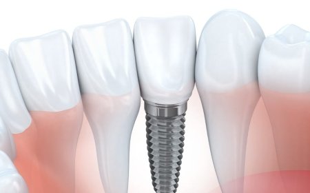 Transform Your Smile with Dentistry for Dental Implants