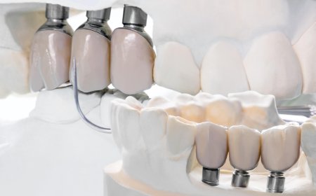 Everything You Need to Know About Dental Bridges in Anchorage