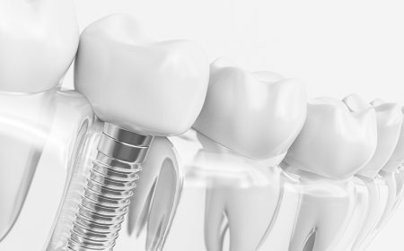 A Complete Guide to Dental Implants in Winslow: Everything You Need to Know