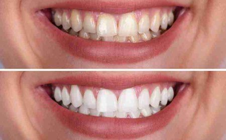 Tooth Whitening Results: Before and After with WHITECARE