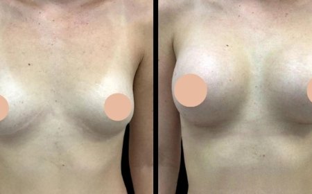 Choosing Between Saline and Silicone with the Best Breast Augmentation Surgeon in Dubai