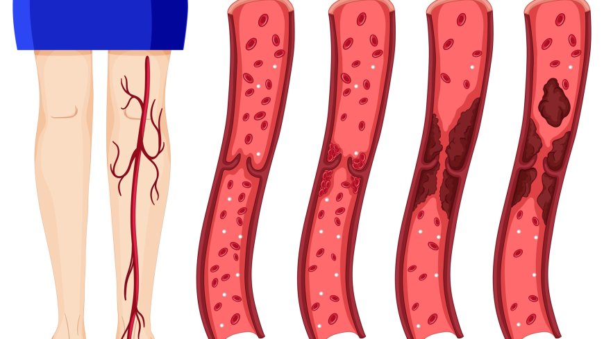 10 Common Blood Clot in Leg Symptoms and When to See a Doctor